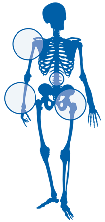skelett blå osteoporos